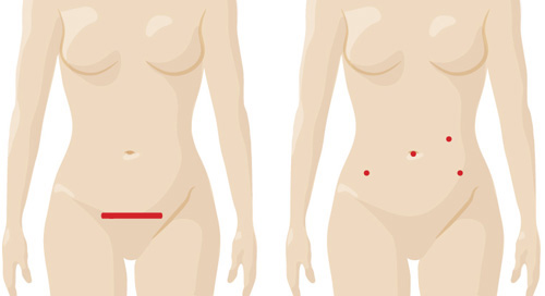 Benign hysterectomy incision comparisons