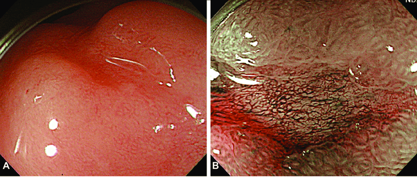 Early-gastric-cancer-A-A-depressed-lesion-was-noted-at-the-antrum-B-Magnifying