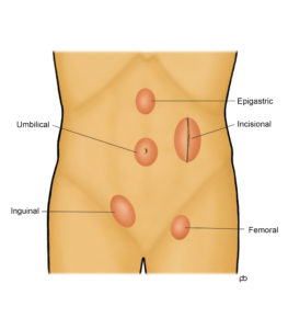 Fig-1-hernias-text-263x300-263x300
