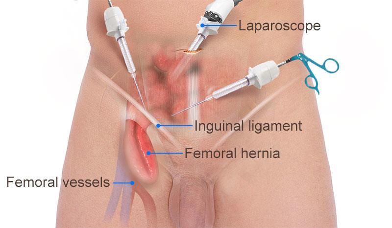 Laparoscopic-femoral-Hernia-repair