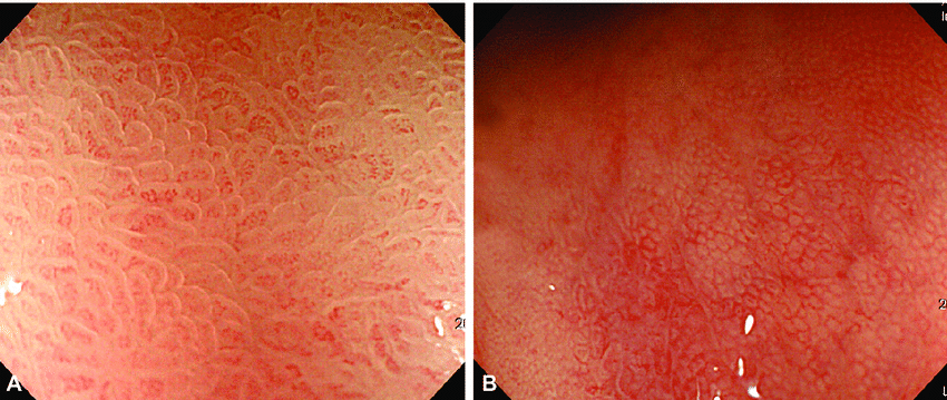 Magnifying-endoscopic-finding-of-normal-gastric-mucosa-A-In-the-gastric-antrum