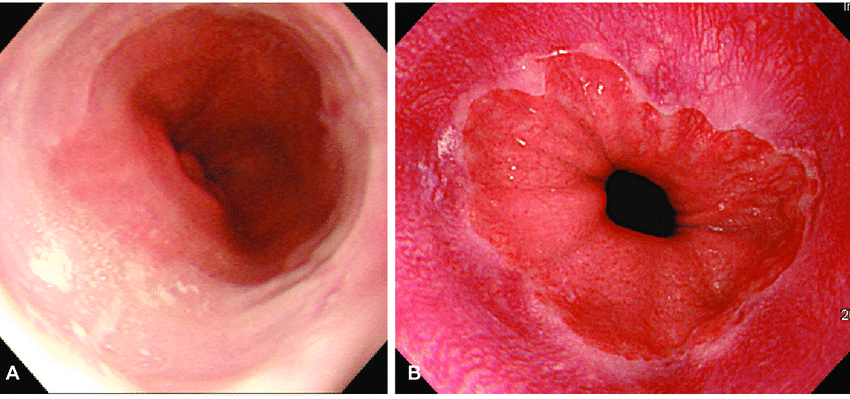 The-resolution-of-endoscopic-image-A-Standard-definition-SD-endoscopic-image-of