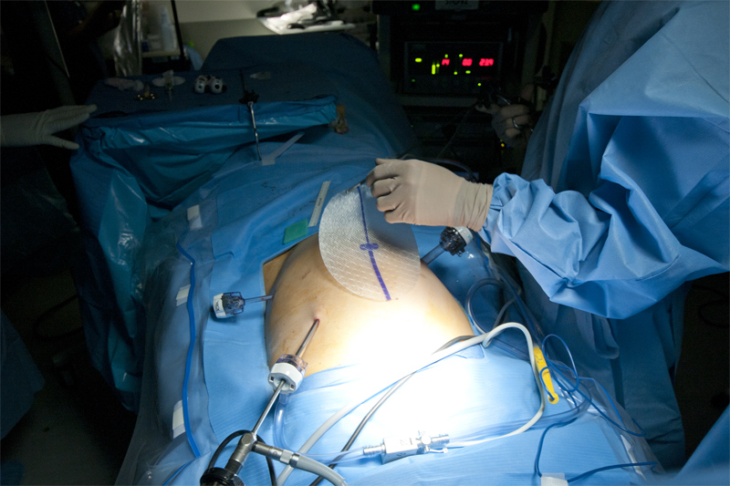 VentralHernia2