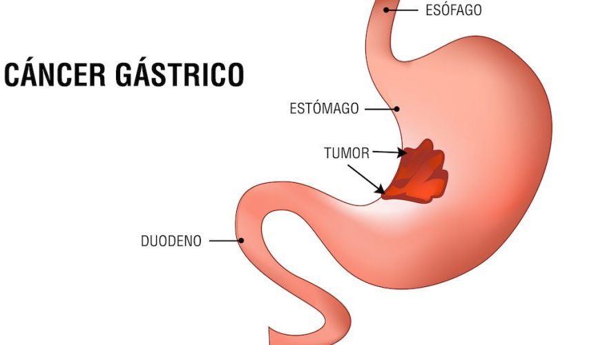 cancer-gastrico-detectar-860x500