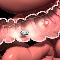 capsula-endoscopica