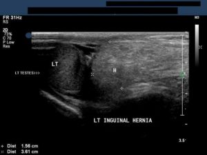 inguinal-hernia-3a-300x225