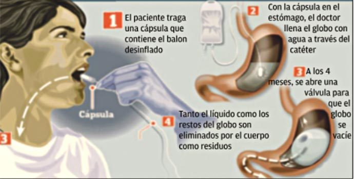 proceso-colocacion-balon-gastrico-ingerible-digerible