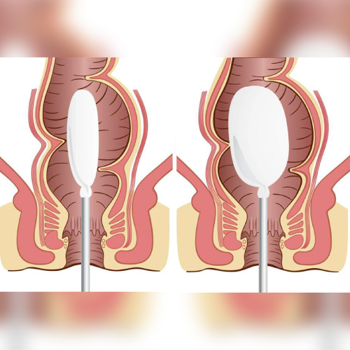 Manometría Anorrectal