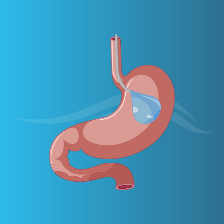 Gastric-Balloon-Turkey-2 balon gastrico
