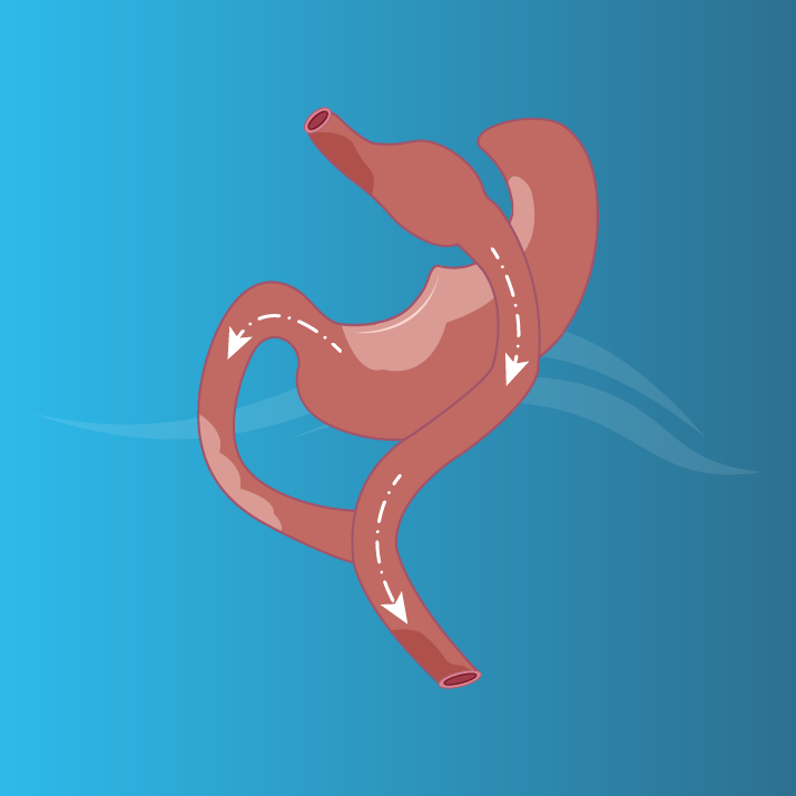 Gastric-Bypass-Turkey-1 BYPASS GASTRICO
