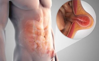 Hernia inguinal en hombres: ¿por qué es común y cómo se trata?