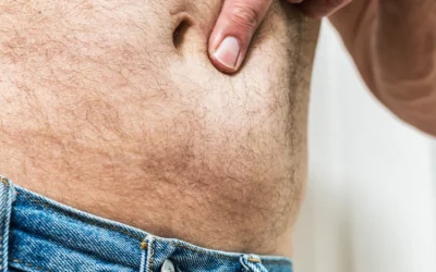 Hernia abdominal: causas y tratamiento