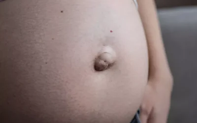 Hernia umbilical: qué es y cómo tratarla
