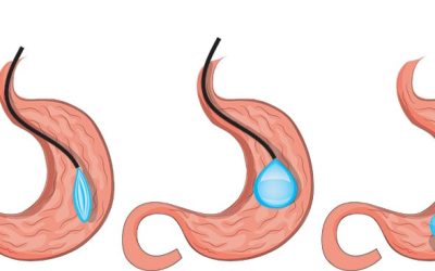 Balón intragástrico: cómo funciona y cuáles son sus beneficios para la obesidad