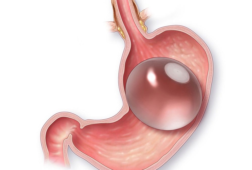 Balón intragástrico: ¿la mejor opción para tratar la obesidad?