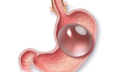 Balón intragástrico: ¿la mejor opción para tratar la obesidad?