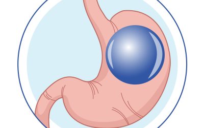 Balón intragástrico: solución no quirúrgica para la obesidad