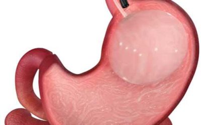Balón intragástrico: ¿qué es y cómo ayuda a combatir la obesidad?